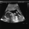Ultraljud: Vår bebis v17+4